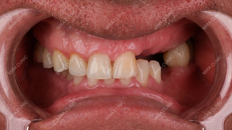 Missing Back Tooth
